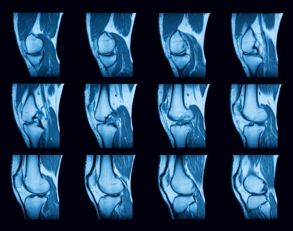 Iliotibial Band Friction Syndrome - MSK Radiology Imaging