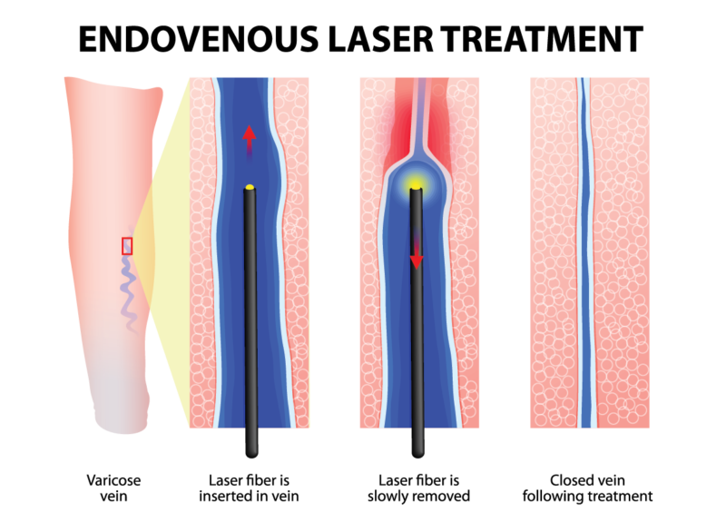 Venous Insufficiency Treatment