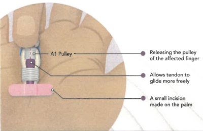 Benefits of Trigger Finger Release - Winchester Radiologists